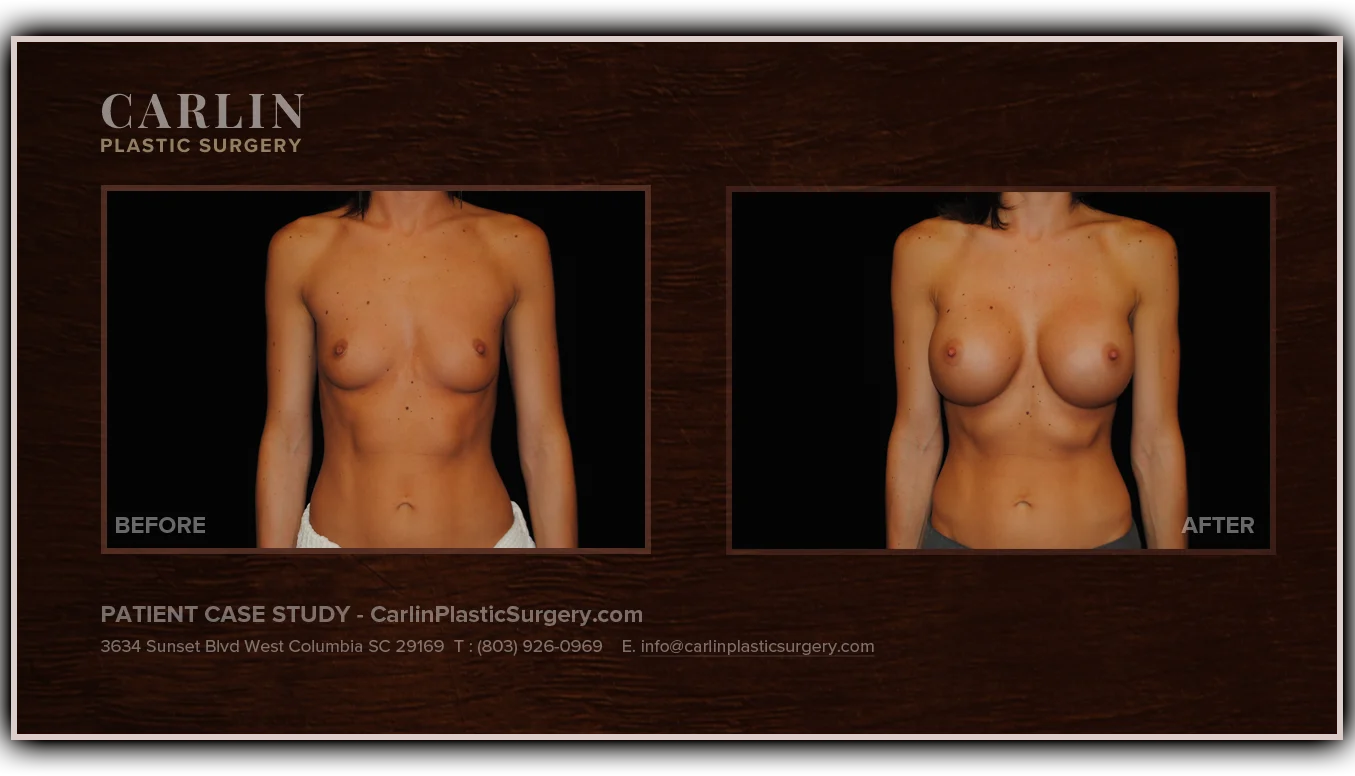 Breast Augmentation before and after — patient 11, front view