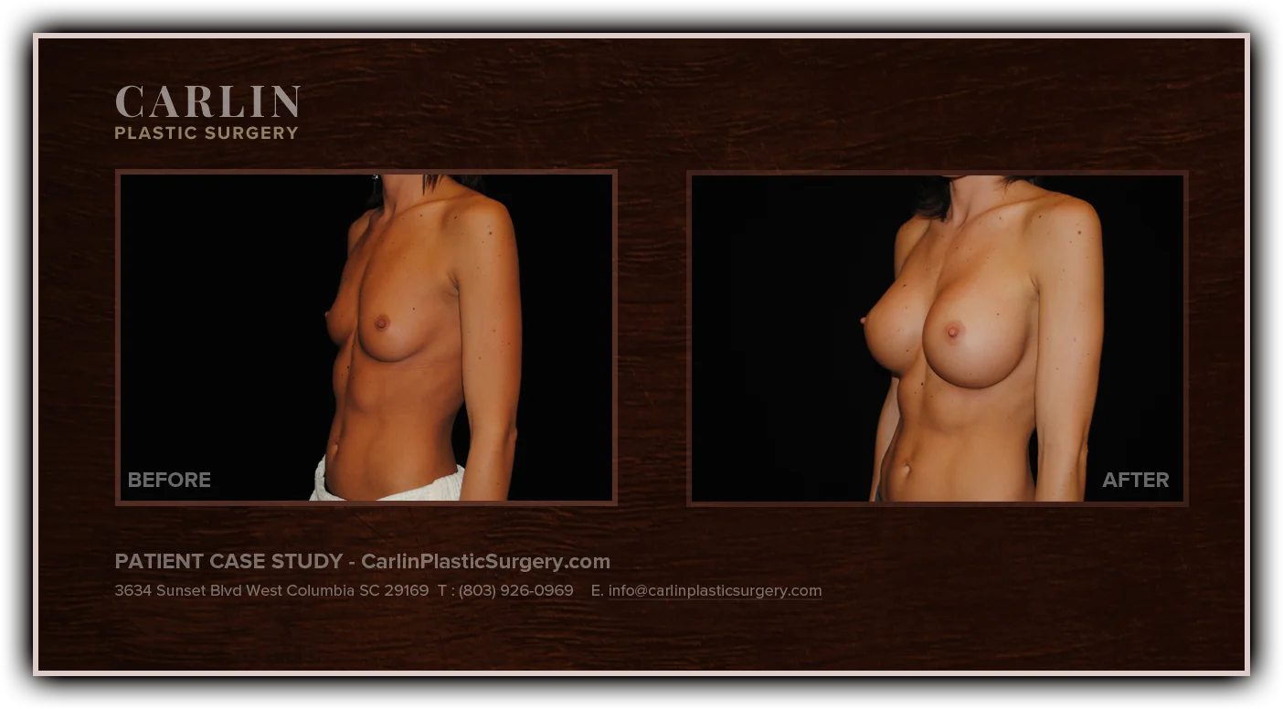 Breast Augmentation before and after — patient 11, side view left