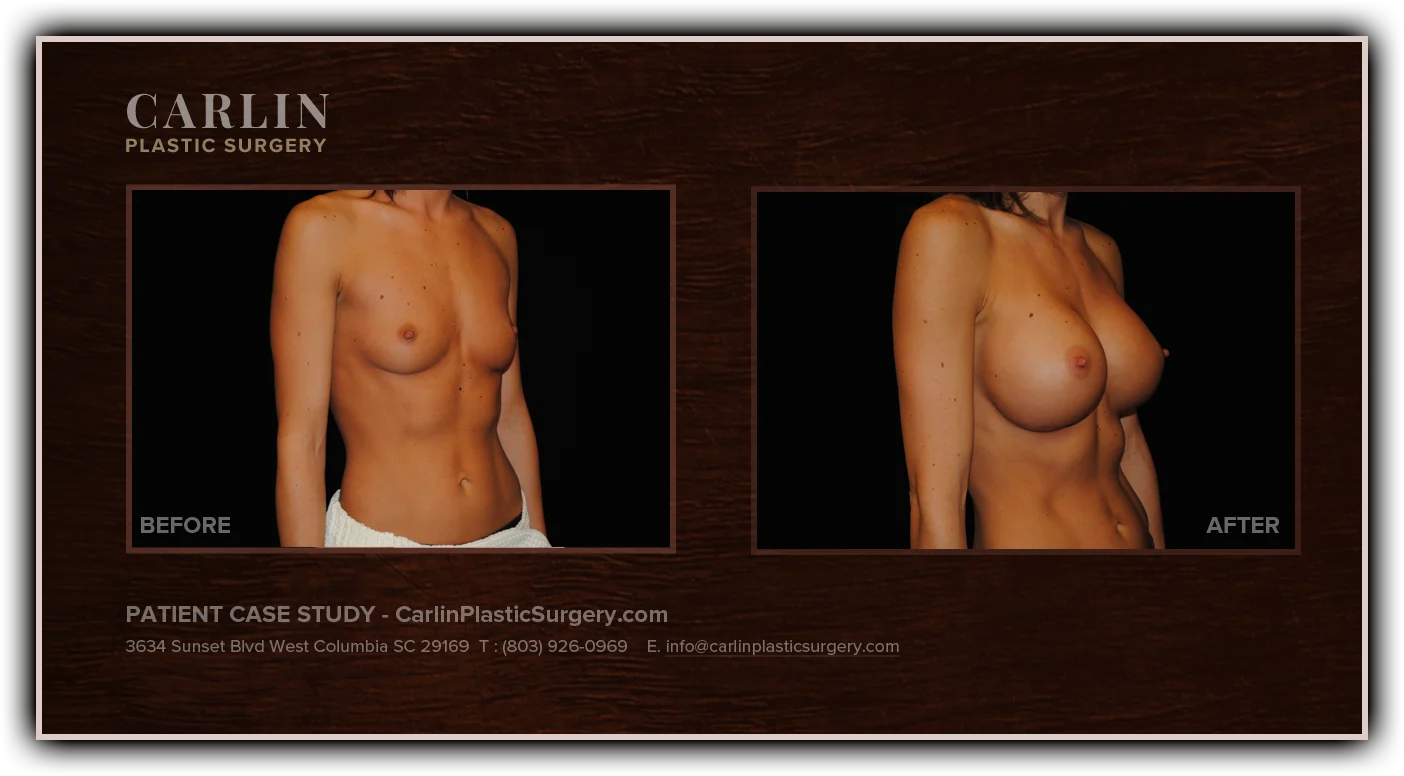 Breast Augmentation before and after — patient 11, side view right