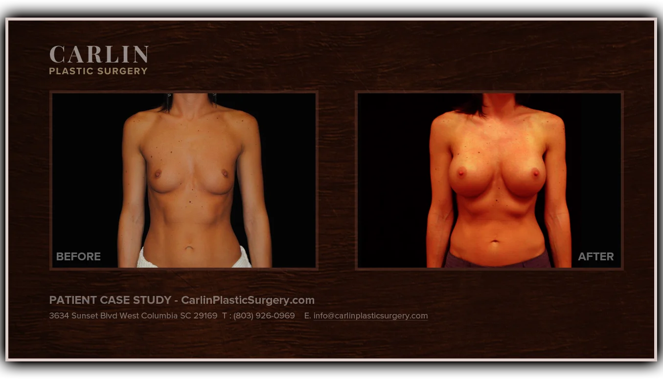 Breast Augmentation before and after — patient 12, front view