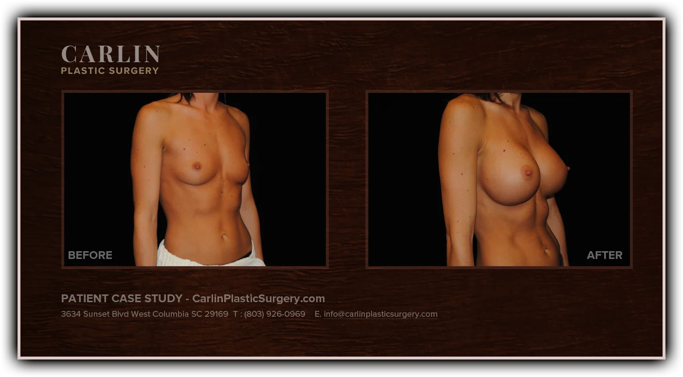Breast Augmentation before and after — patient 12, side view right