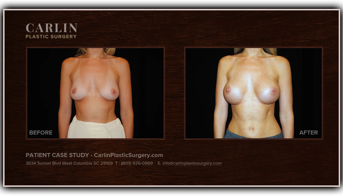 Breast Augmentation before and after — patient 13, front view