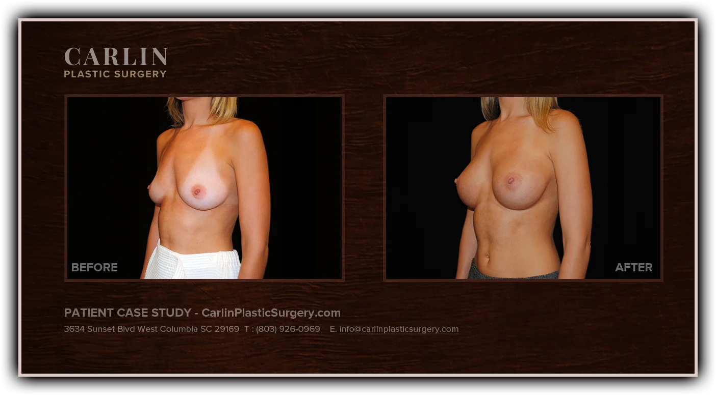 Breast Augmentation before and after — patient 13, side view left
