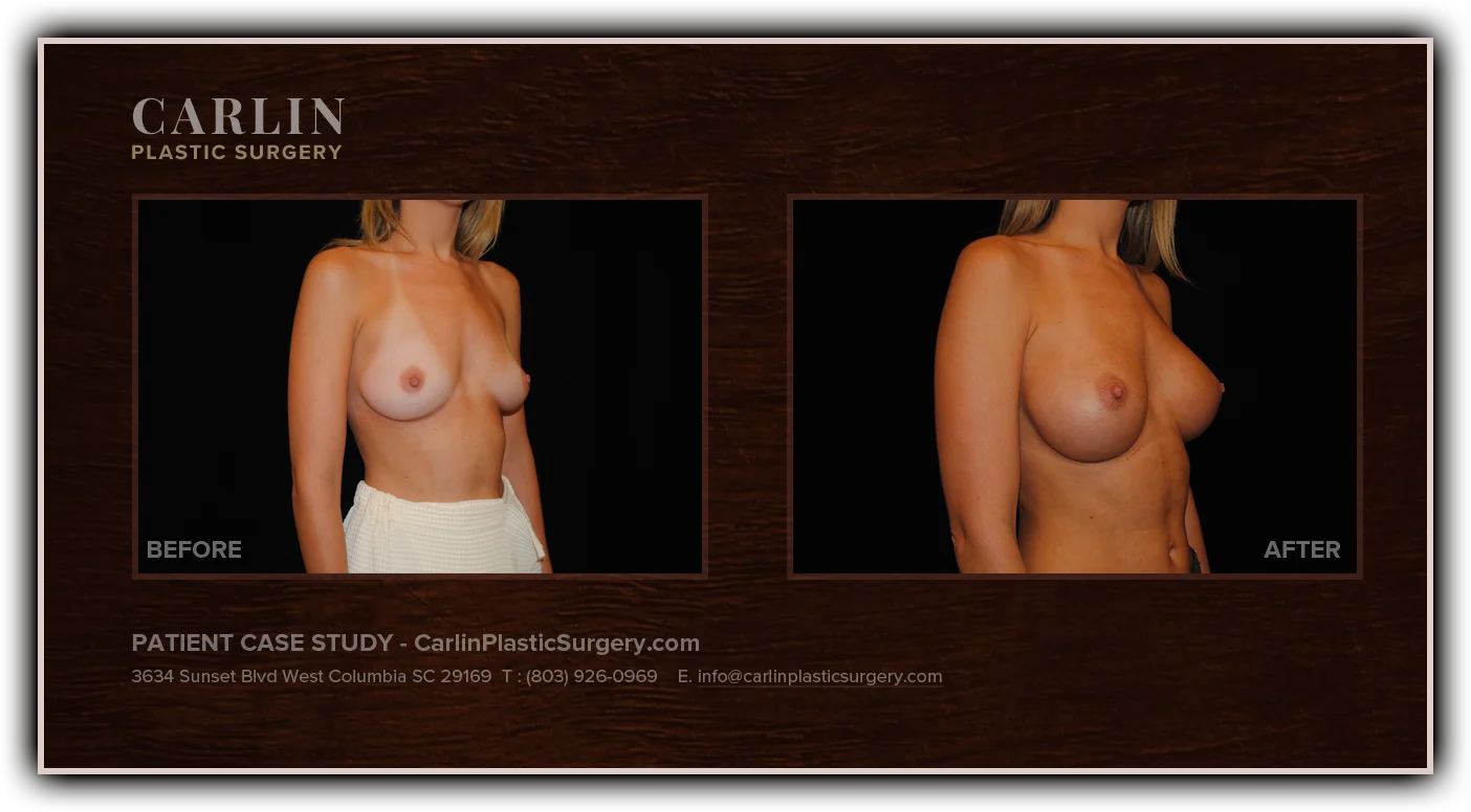 Breast Augmentation before and after — patient 13, side view right