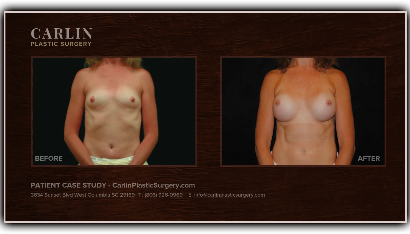 Breast Augmentation before and after — patient 14, front view