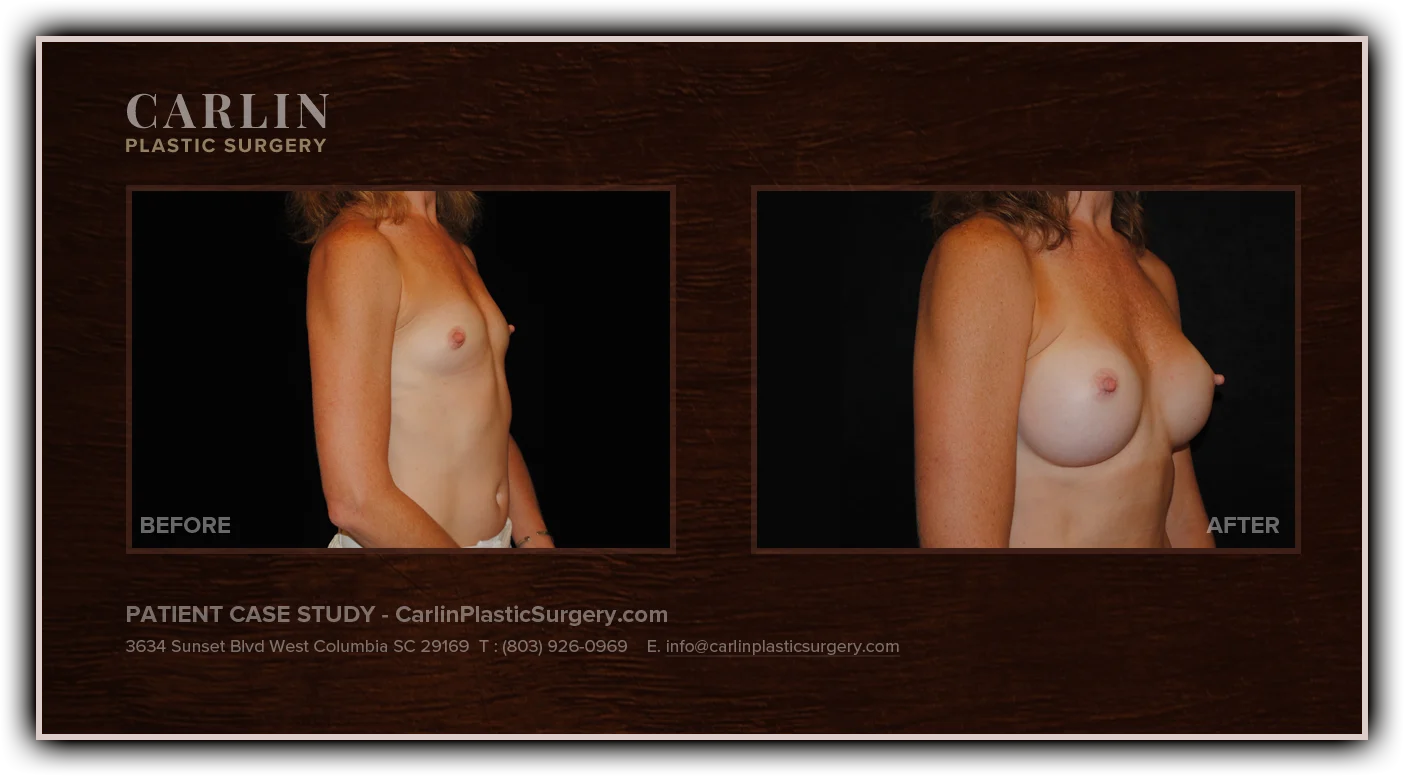 Breast Augmentation before and after — patient 14, side view right