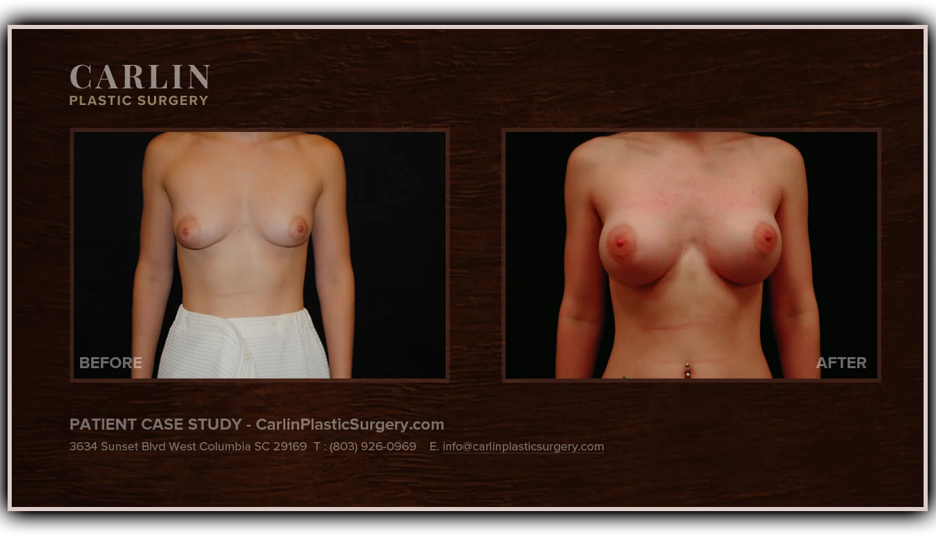 Breast Augmentation before and after — patient 15, front view