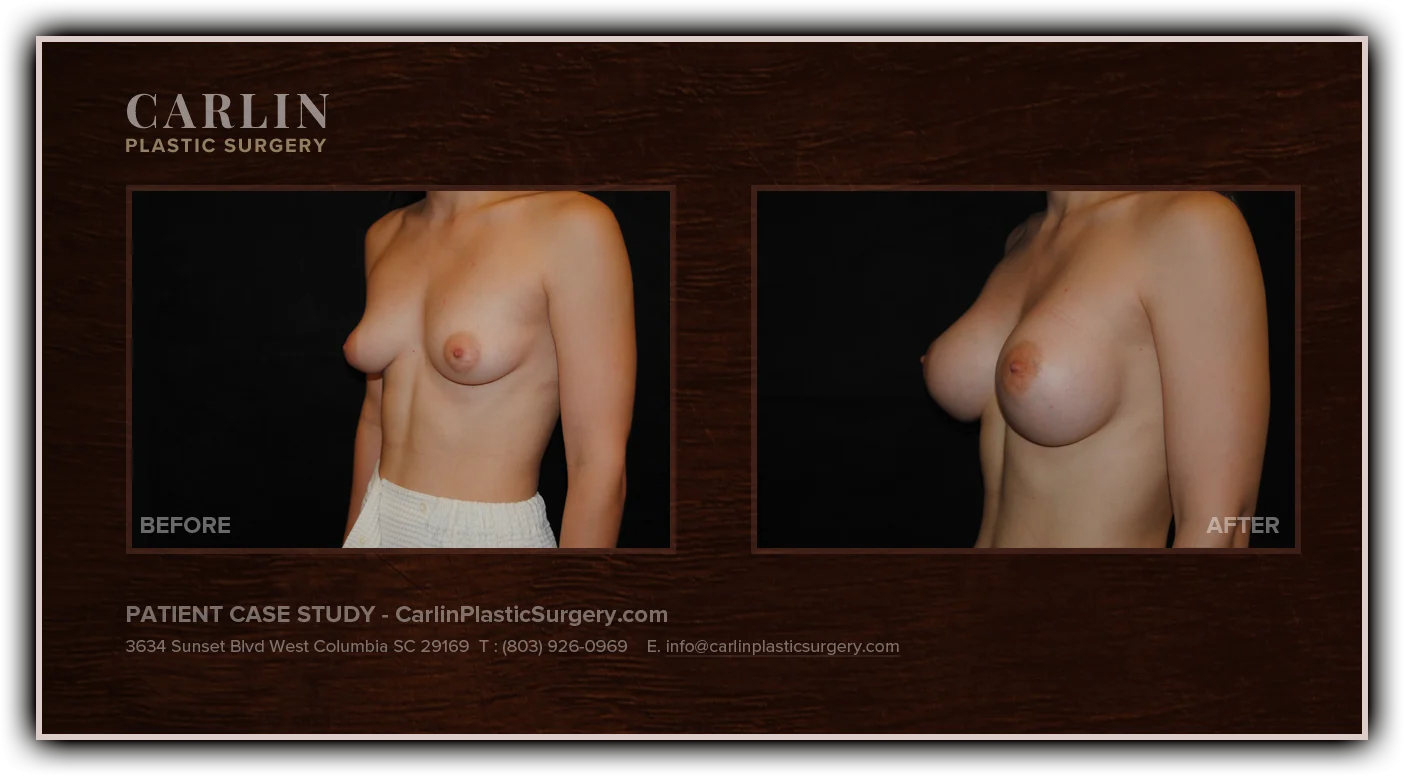 Breast Augmentation before and after — patient 15, side view left