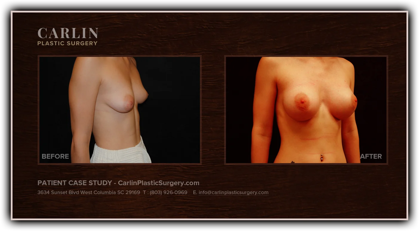 Breast Augmentation before and after — patient 15, side view right