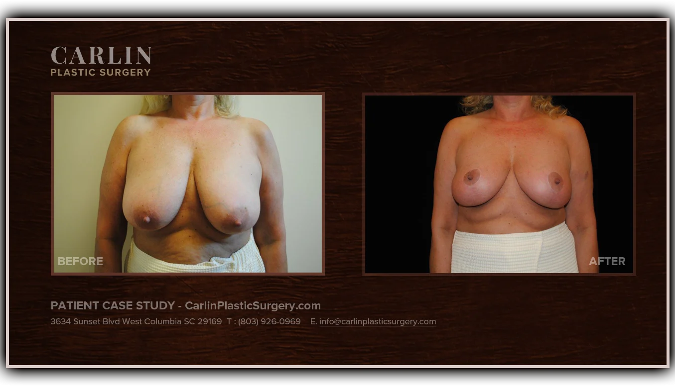 Breast Lift before and after — patient 16, front view