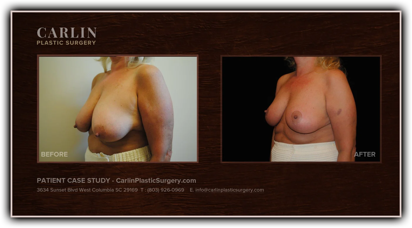 Breast Lift before and after — patient 16, side view left