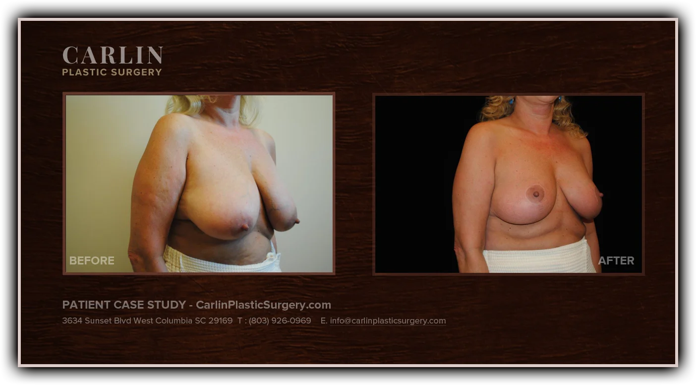 Breast Lift before and after — patient 16, side view right