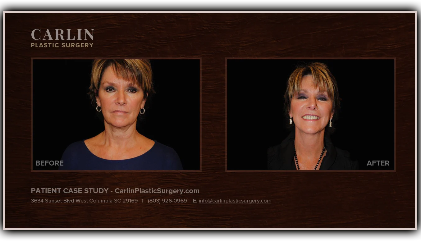 Facelift before and after — patient 19, front view