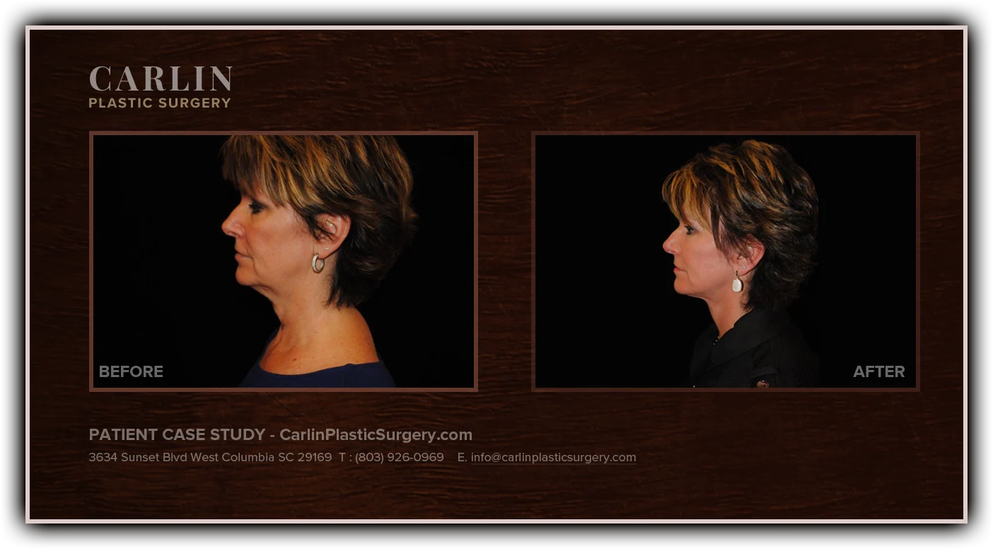 Facelift before and after — patient 19, profile view