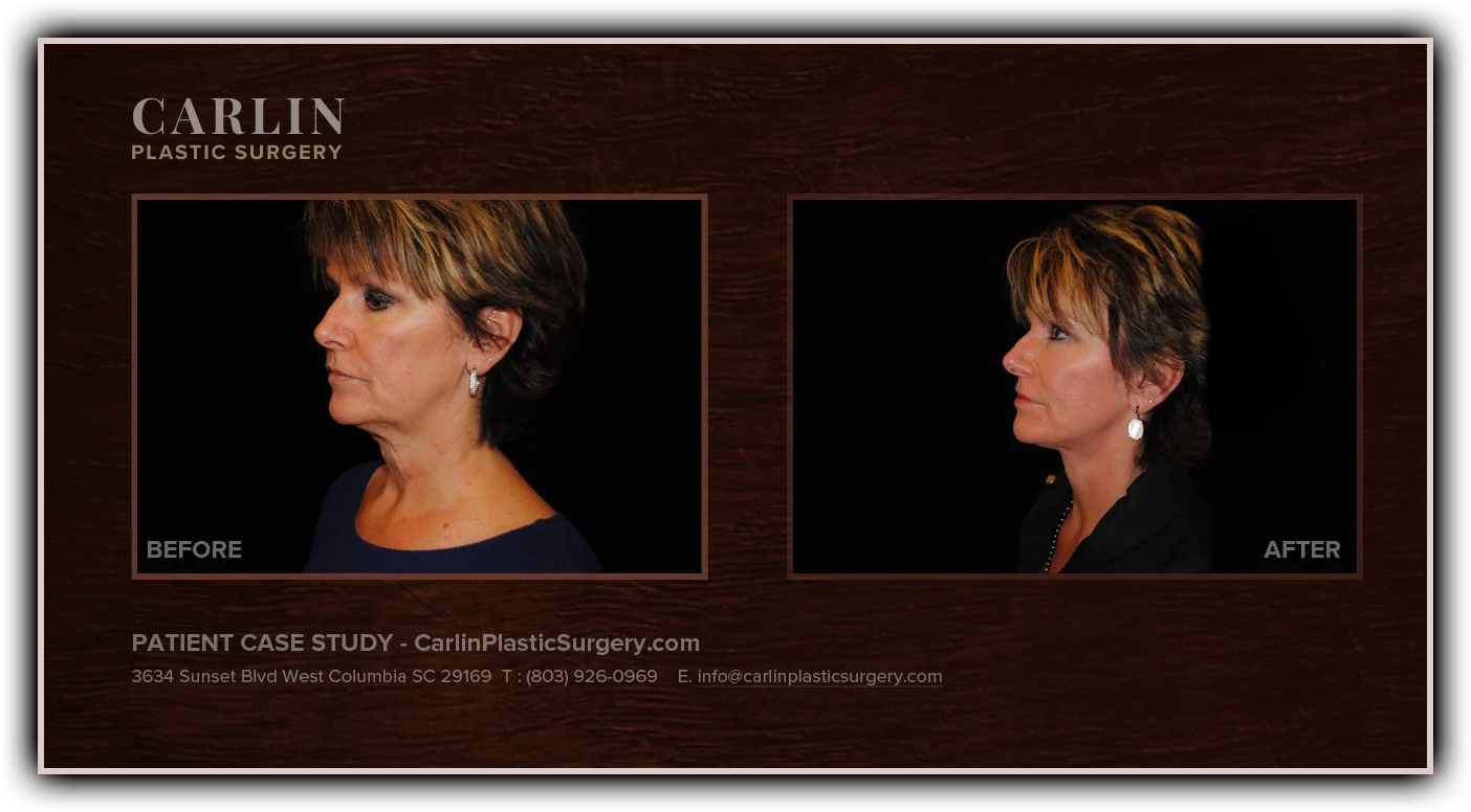 Facelift before and after — patient 19, side view
