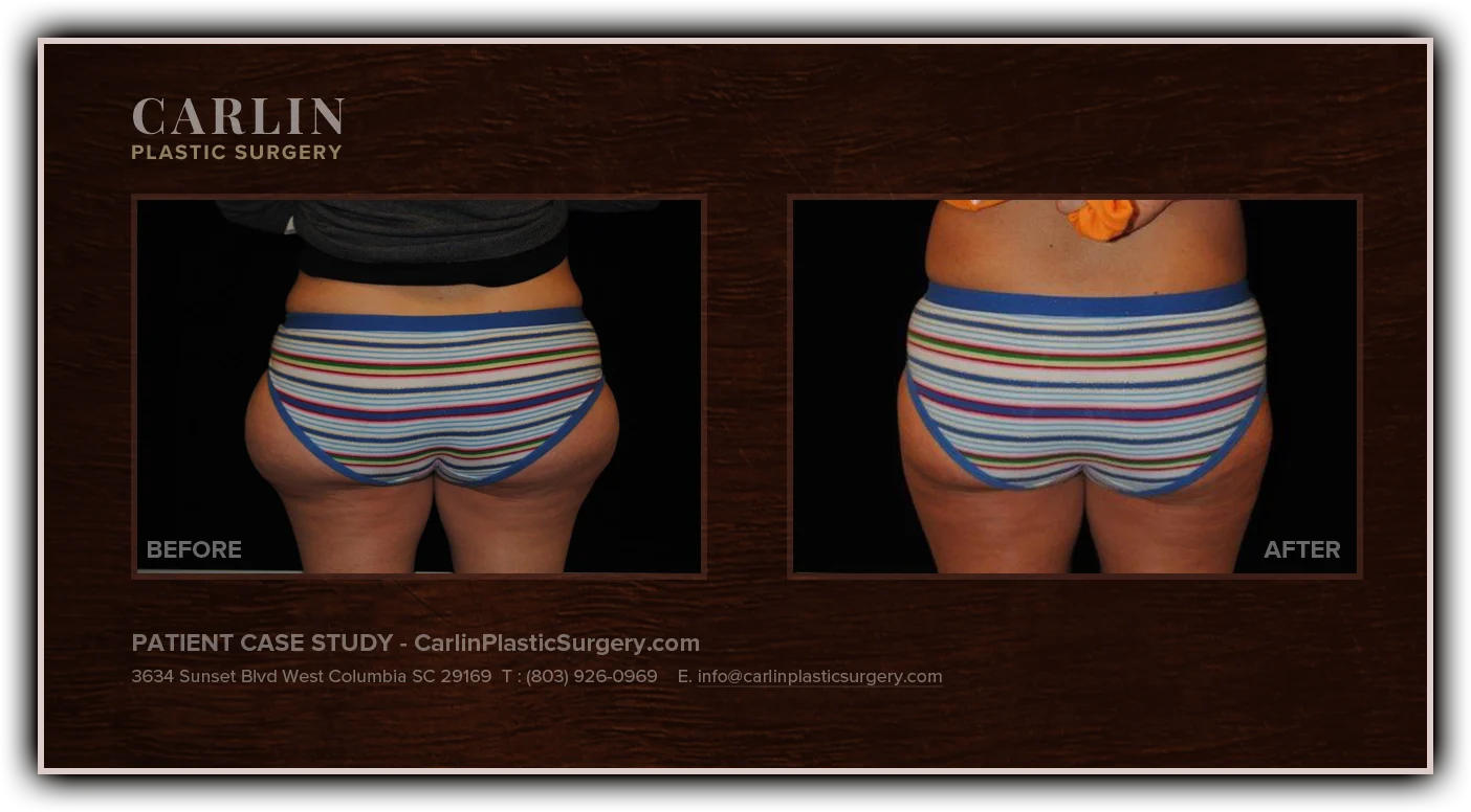 Liposuction before and after — patient 18, back view