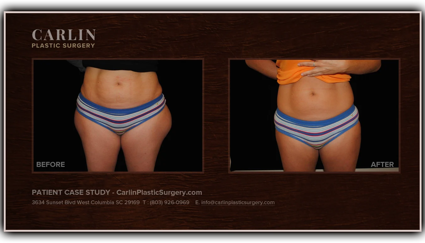 Liposuction before and after — patient 18, front view