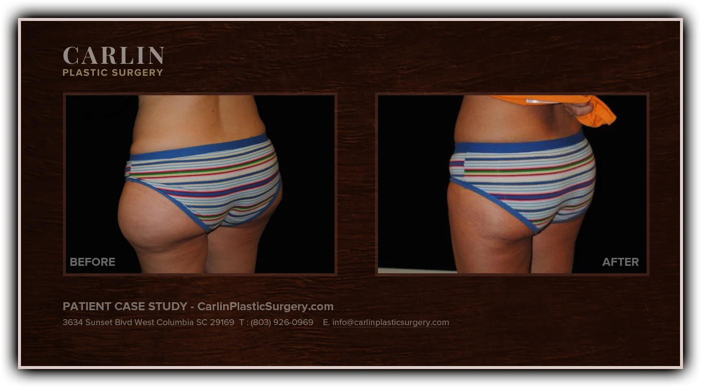 Liposuction before and after — patient 18, side view left