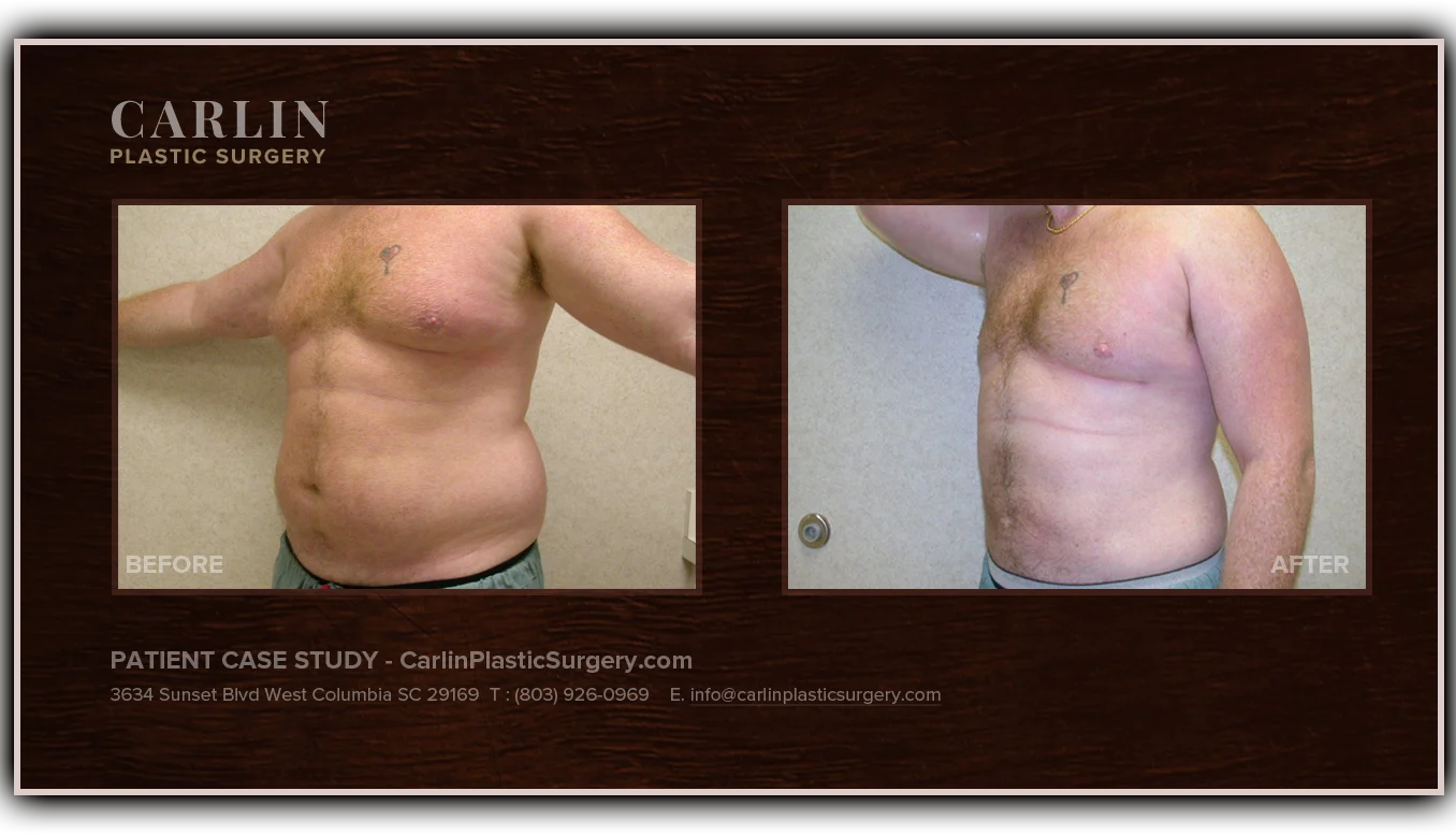 Male Breast Reduction before and after — patient 17, front view