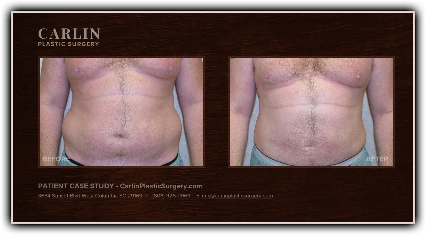 Male Breast Reduction before and after — patient 17, side view left