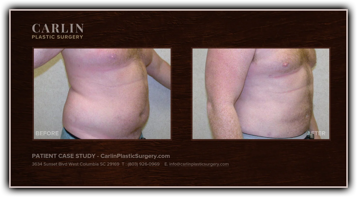 Male Breast Reduction before and after — patient 17, side view right