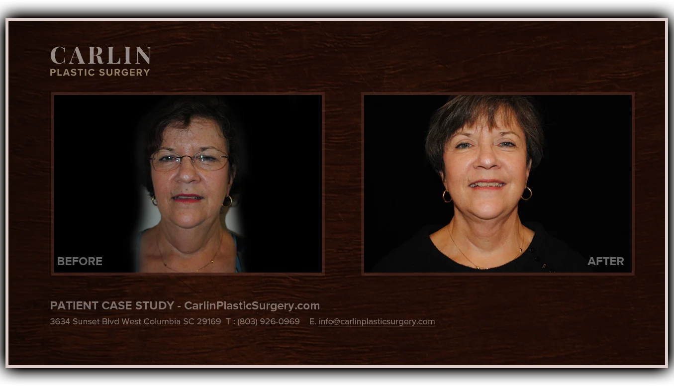 Neck Lift before and after — patient 20, front view