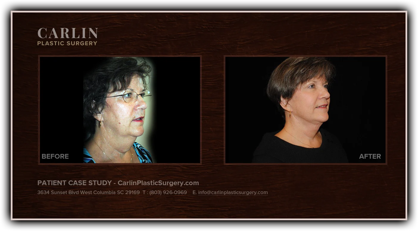 Neck Lift before and after — patient 20, oblique view