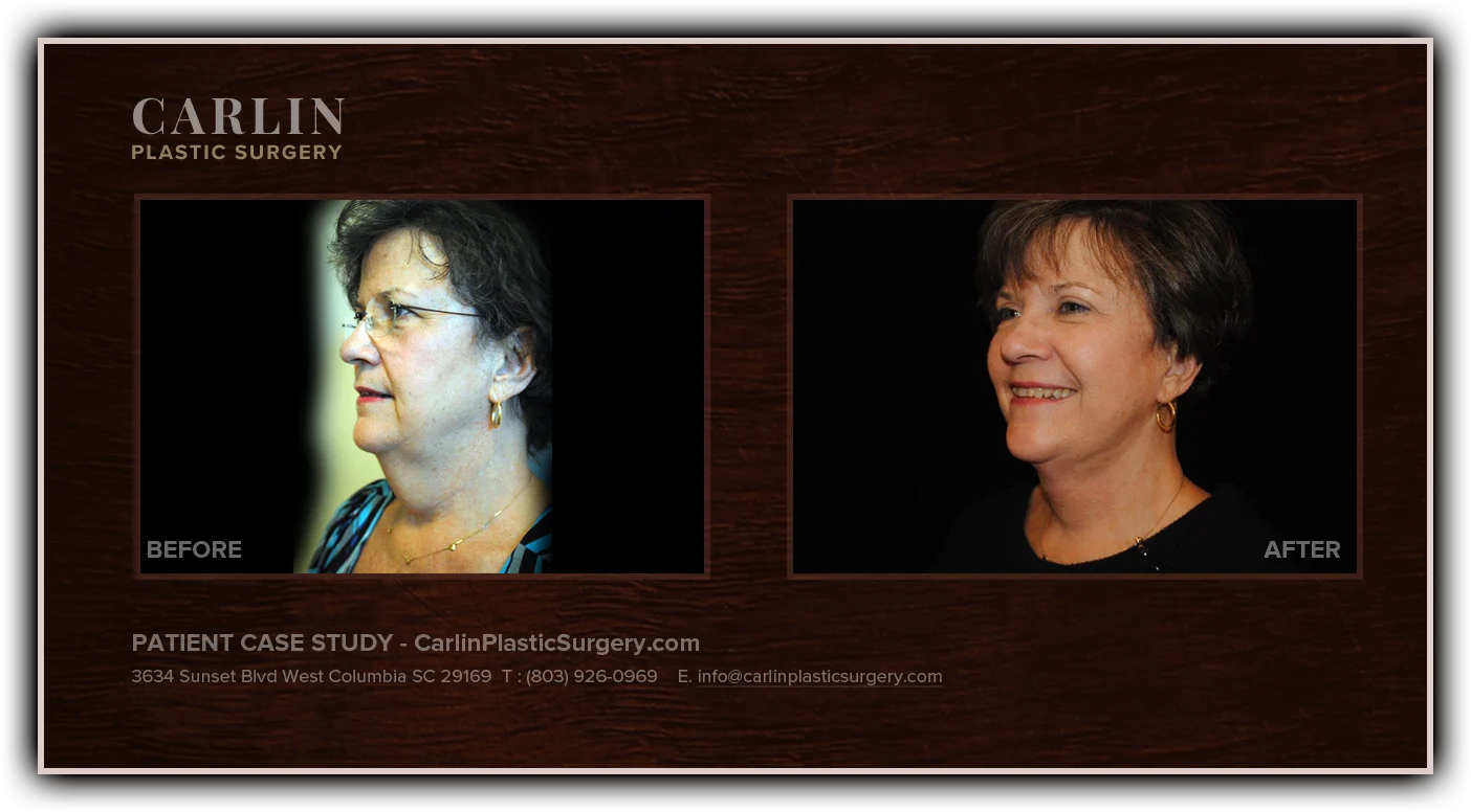 Neck Lift before and after — patient 20, profile view