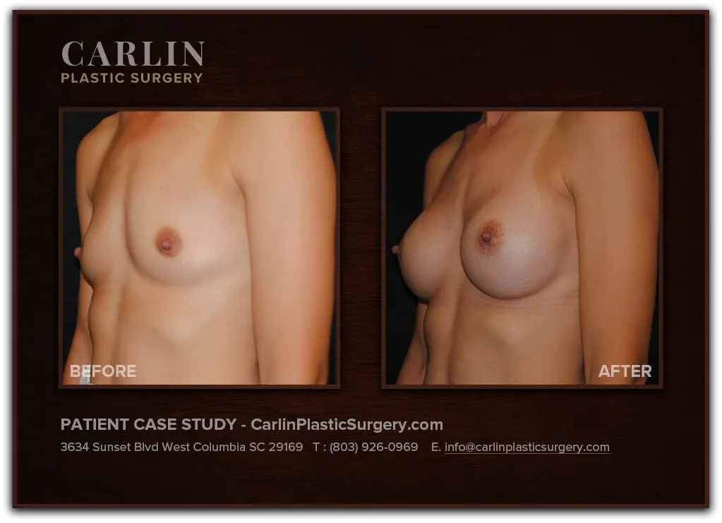 Breast Augmentation before and after — patient 01, left profile view