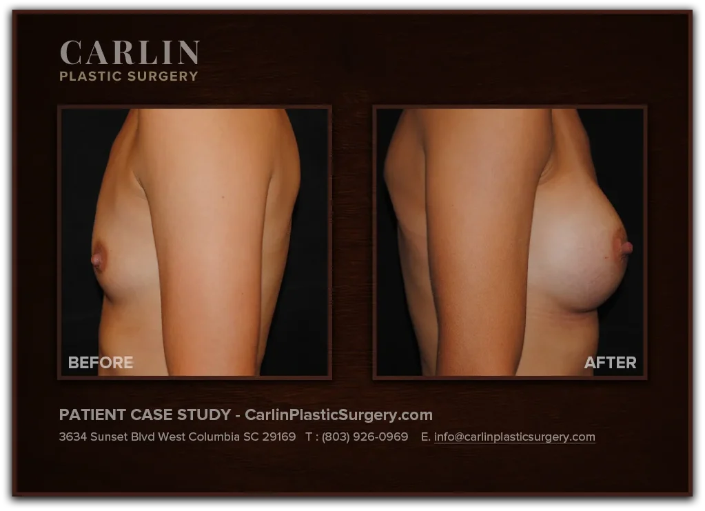 Breast Augmentation before and after — patient 01, side view