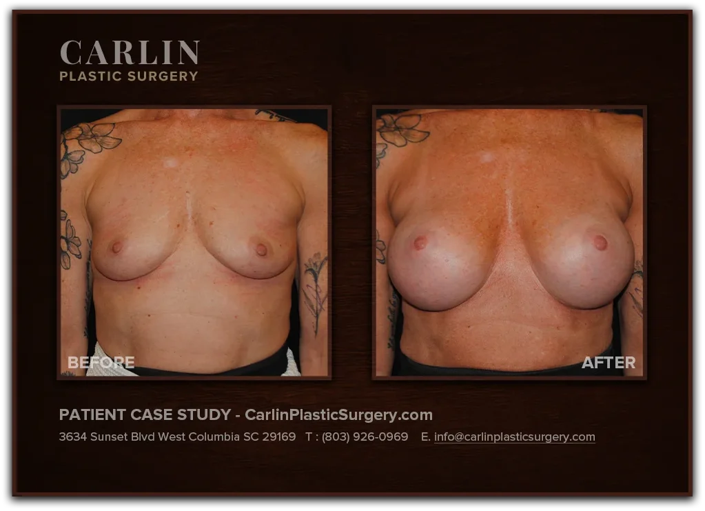 Breast Augmentation before and after — patient 02, front view
