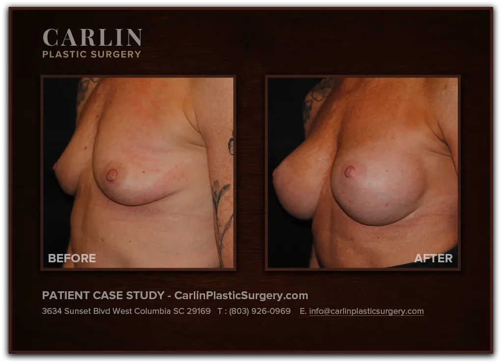 Breast Augmentation before and after — patient 02, left profile view