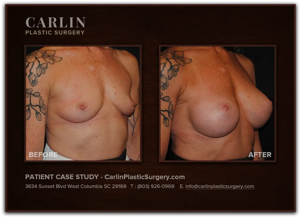 Breast Augmentation before and after — patient 02, right profile view