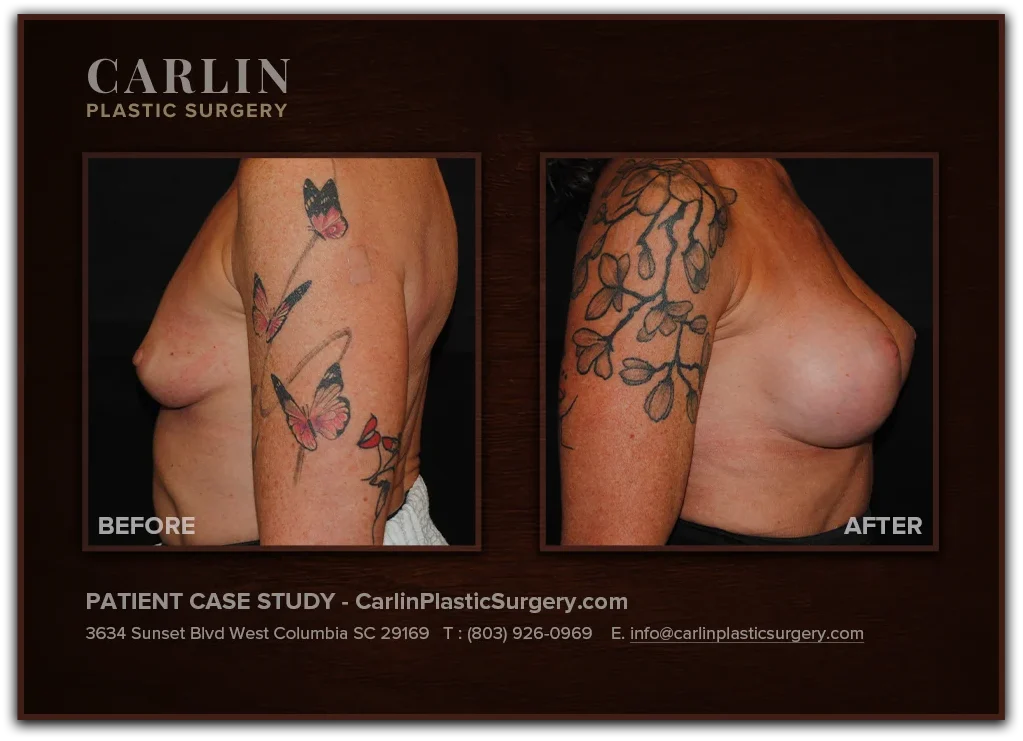 Breast Augmentation before and after — patient 02, side view