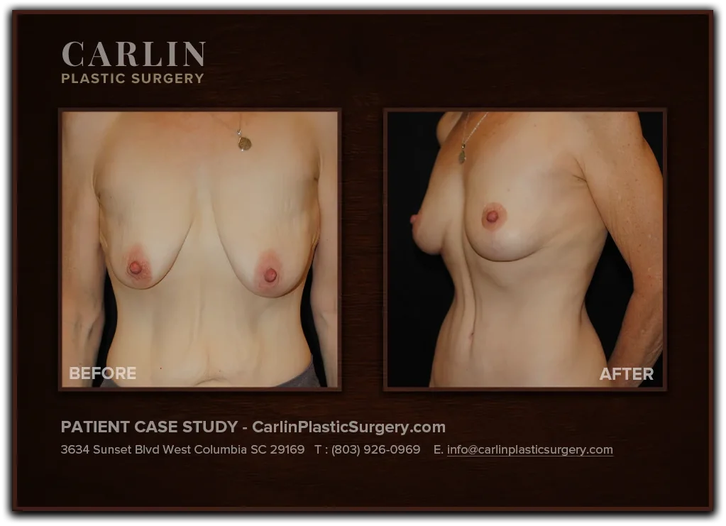 Breast Lift before and after — patient 05, front view