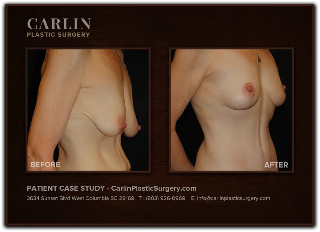 Breast Lift before and after — patient 05, right view