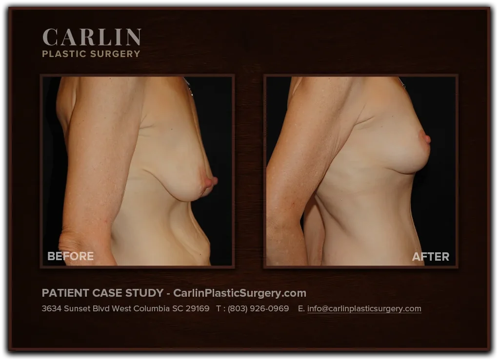 Breast Lift before and after — patient 05, side view