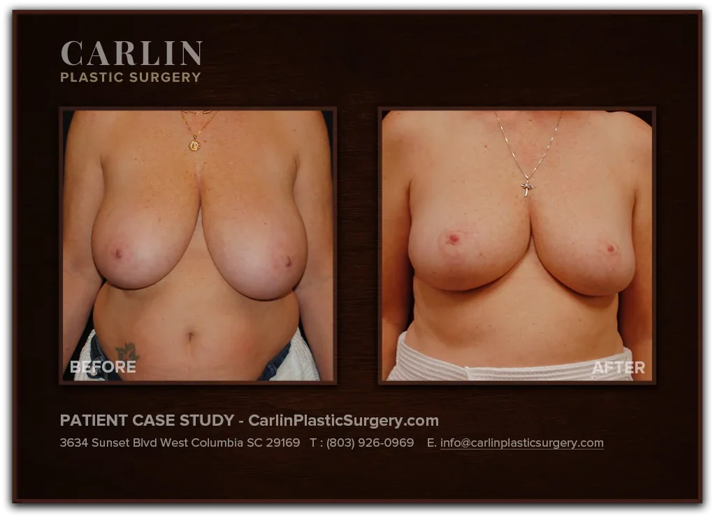 Breast Lift before and after — patient 06, front view