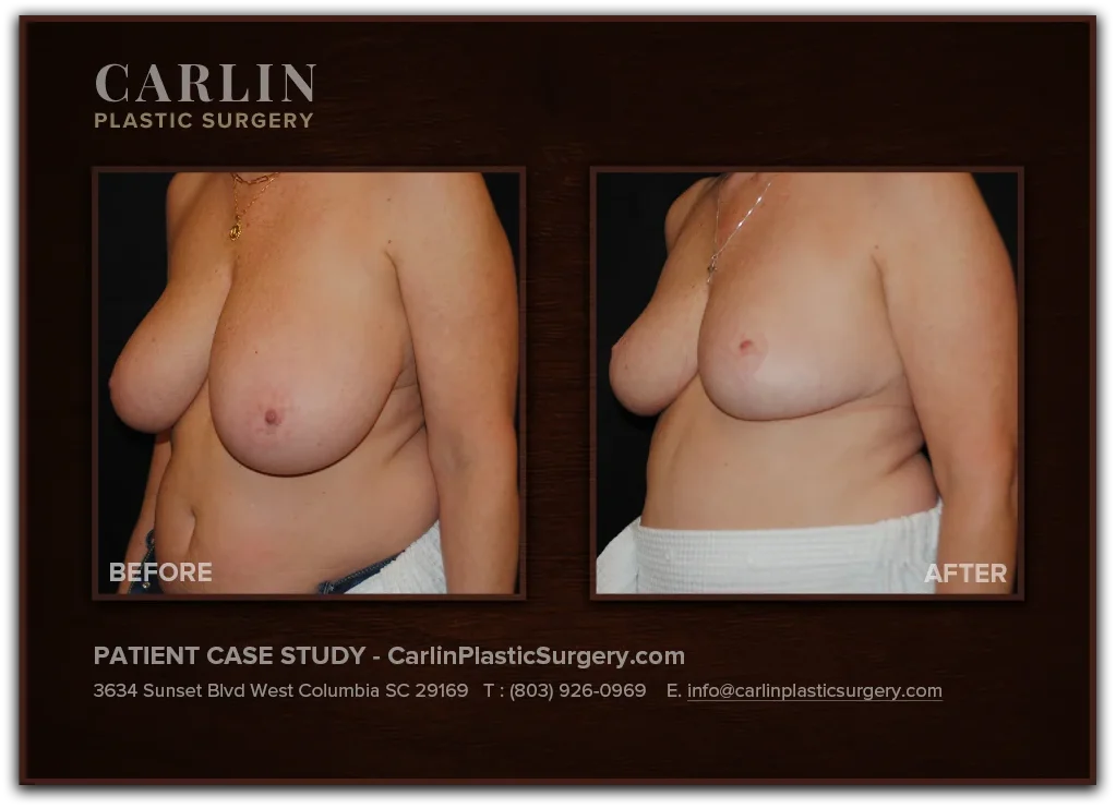 Breast Lift before and after — patient 06, left view
