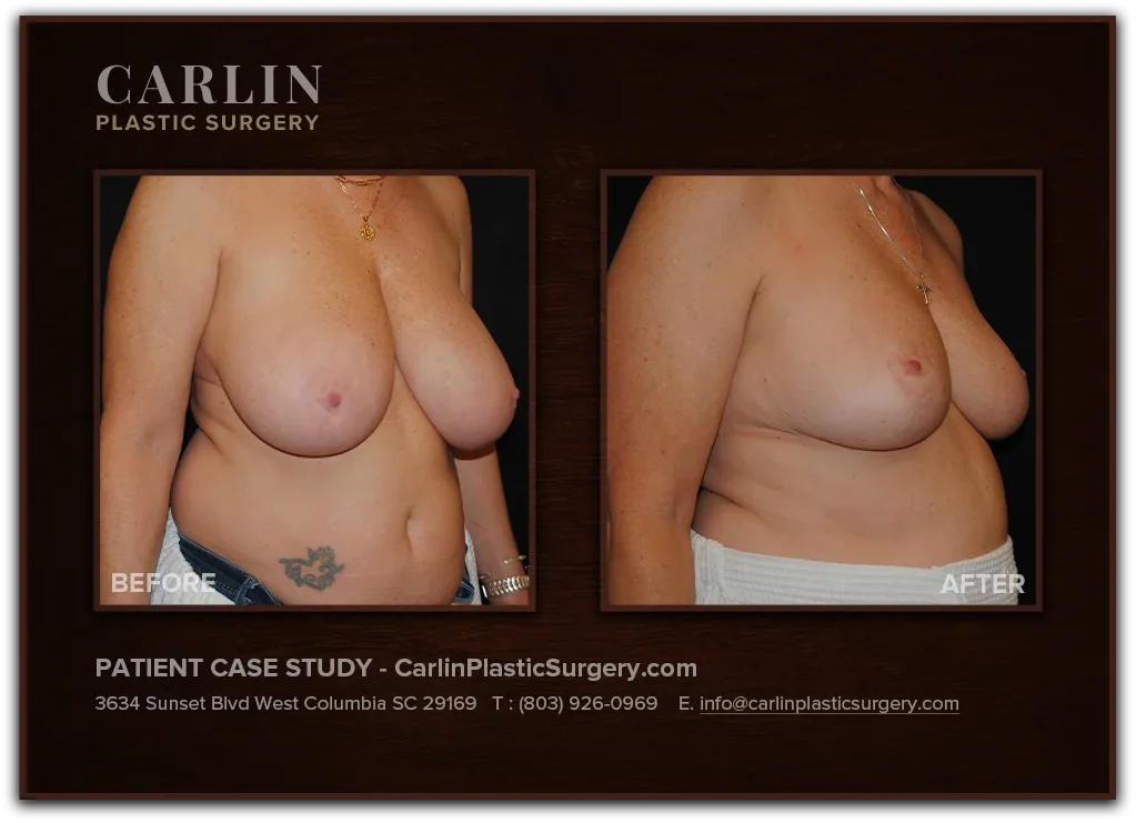 Breast Lift before and after — patient 06, right view
