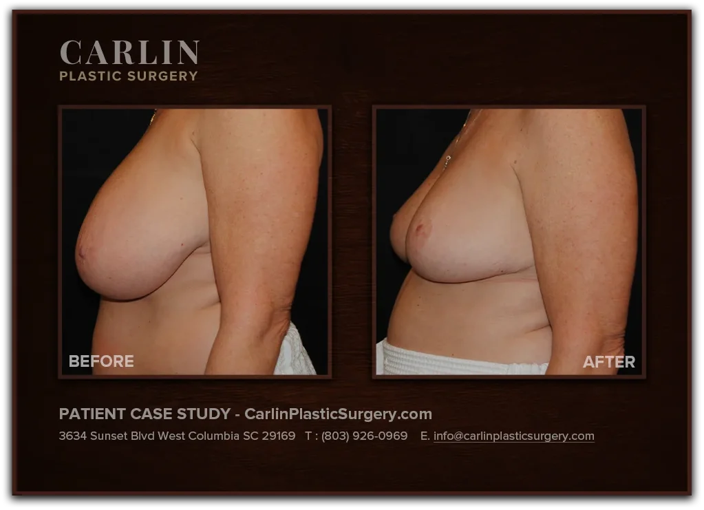 Breast Lift before and after — patient 06, side view