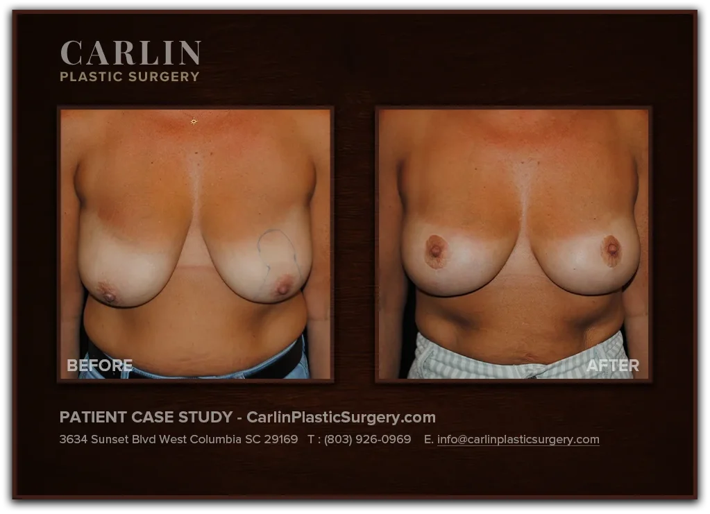 Breast Lift before and after — patient 07, front view