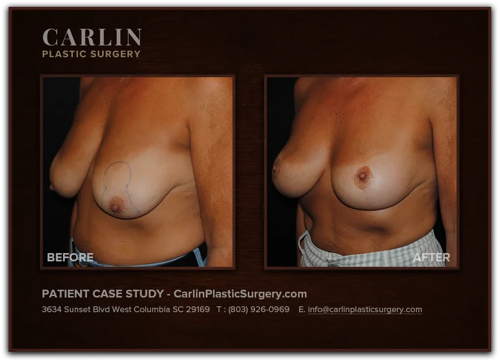 Breast Lift before and after — patient 07, left view