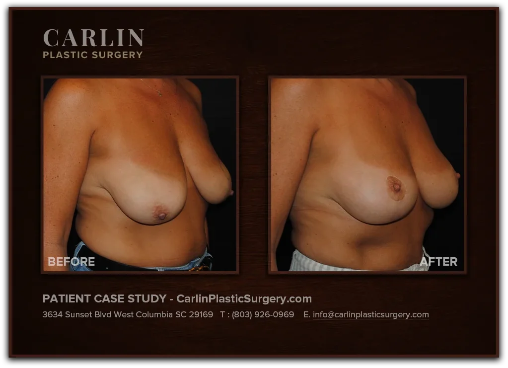 Breast Lift before and after — patient 07, right view