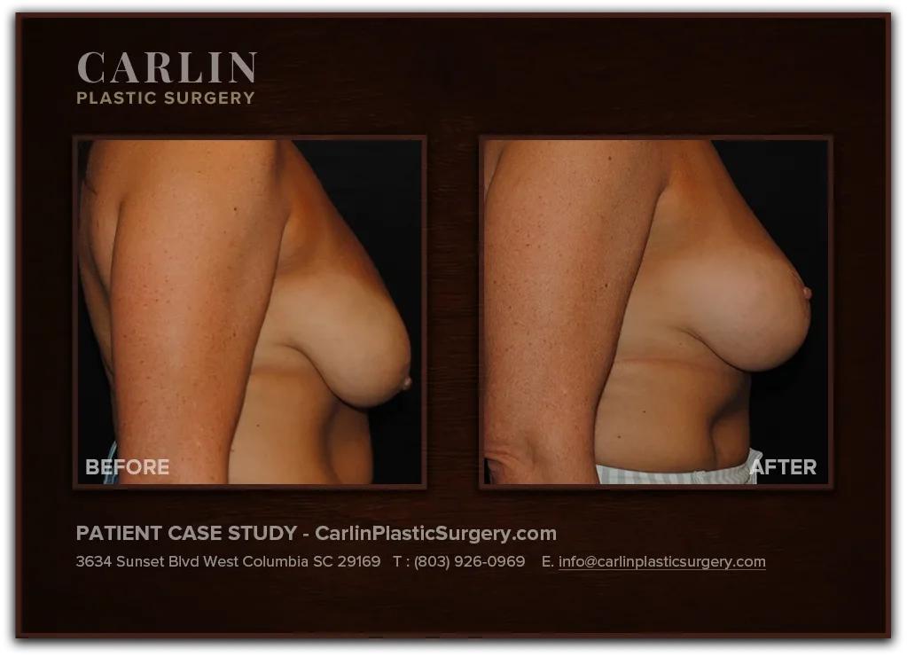 Breast Lift before and after — patient 07, side view