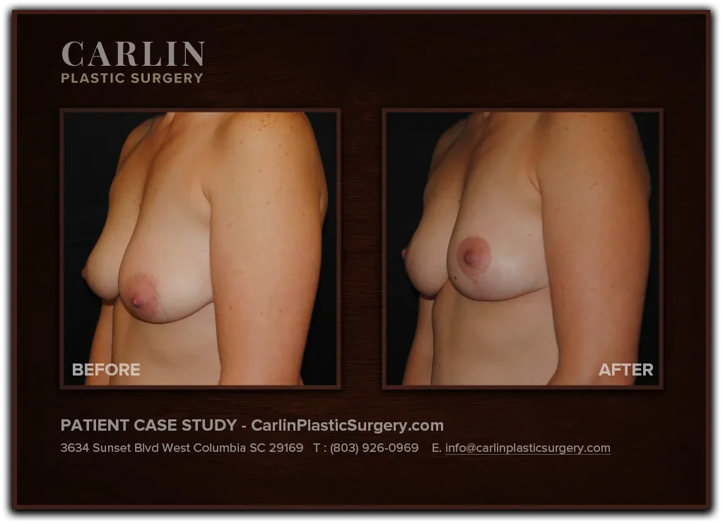 Breast Lift before and after — patient 08, left view