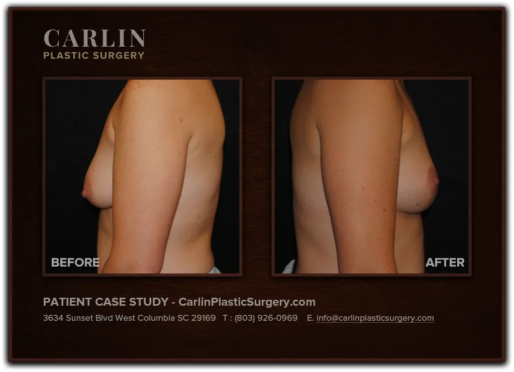 Breast Lift before and after — patient 08, side view