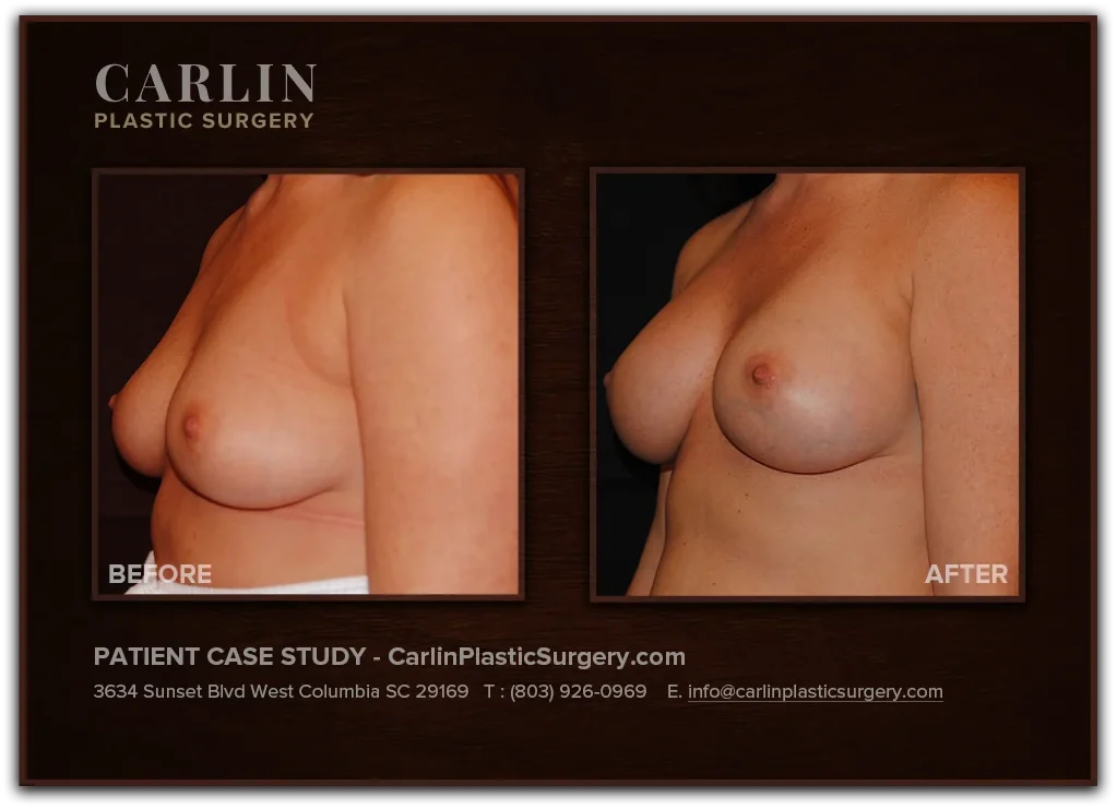 Breast Lift with Augmentation before and after — patient 03, left view