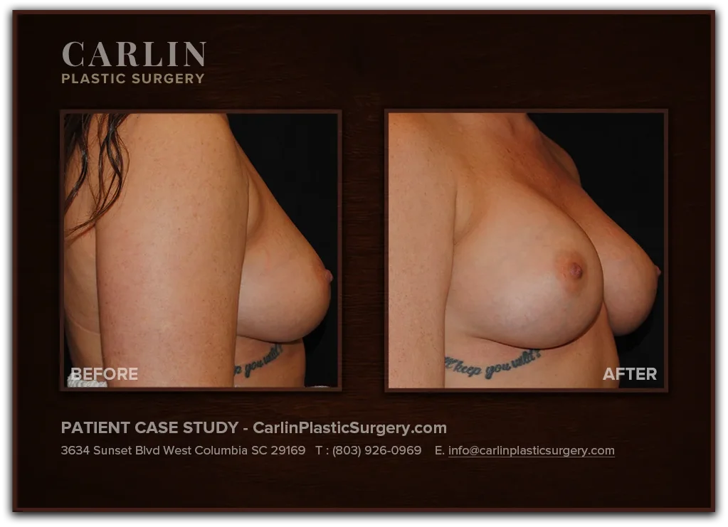 Breast Lift with Augmentation before and after — patient 03, side view