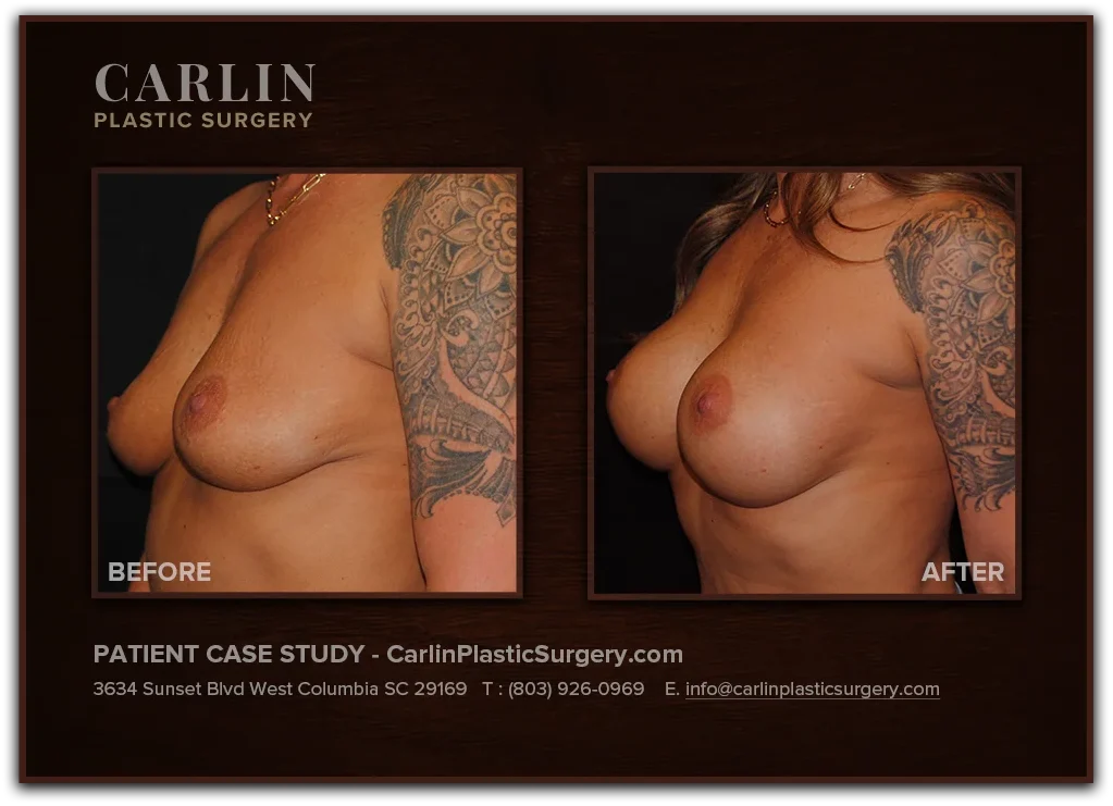 Breast Lift with Augmentation before and after — patient 04, left profile view